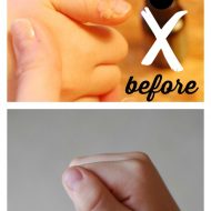 Natural, Effective Wart Removal